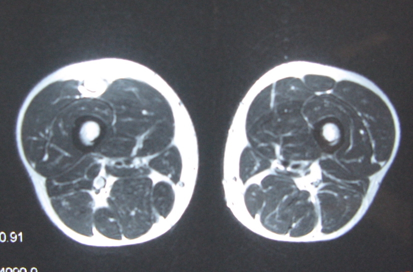Rotura fibrilar recto anterior del cuádriceps - fisioterapiavtoledo.com